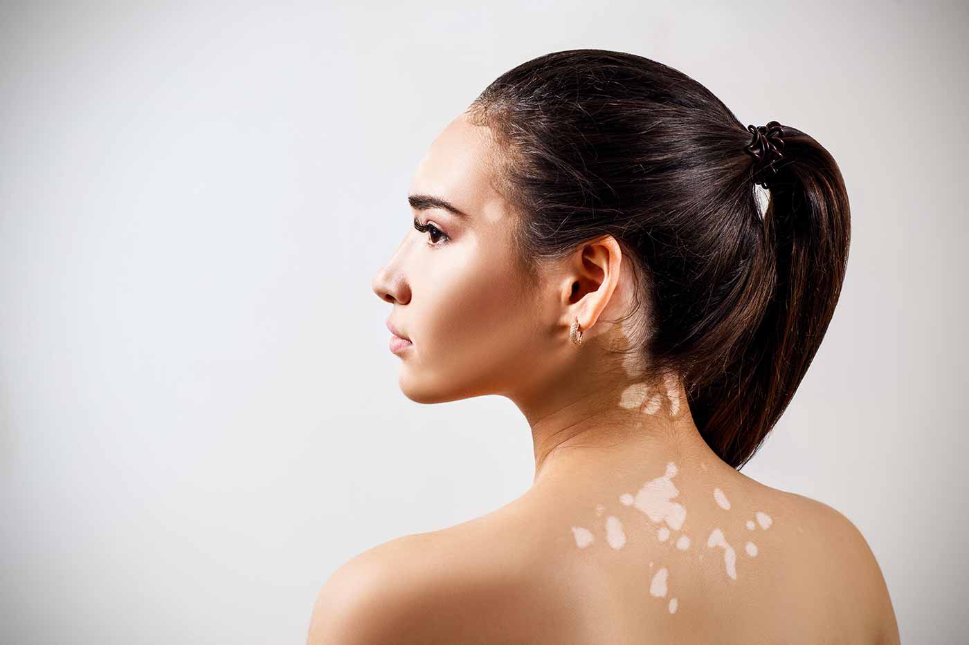 Navigating the Journey of Alopecia and Vitiligo: A Compounding Approach - My Skin Compounding Pharmacy Brisbane